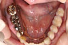 義歯4